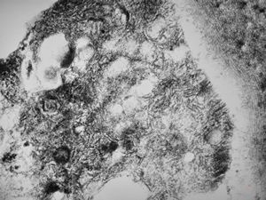 F,25y. | metachromatic leukodystrophy - n.suralis F,25y. | metachromatic leukodystrophy - n.suralis